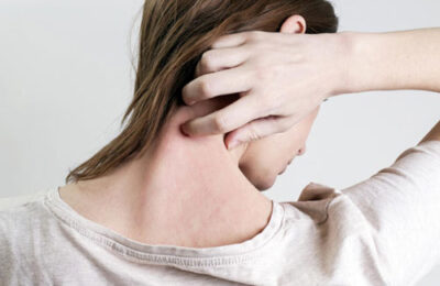 La psoriasis, patología multifactorial: intestino, piel y emoción
