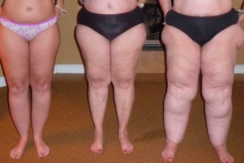 Lipedema: La enfermedad del tejido graso más desconocida